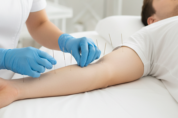 child receiving acupuncture on upper back
